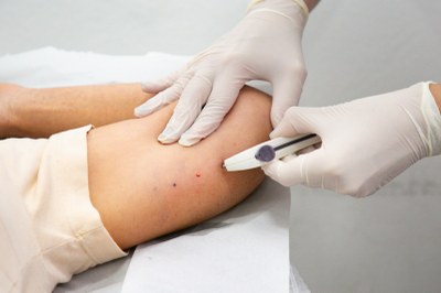 Itaguaí inicia oferta de implante contraceptivo Implanon pelo SUS